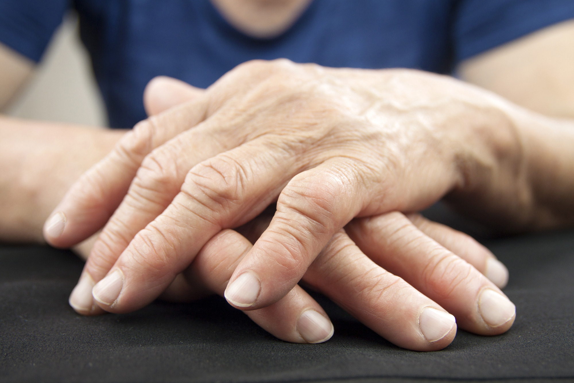 Natural Treatment For Severe Rheumatoid Arthritis